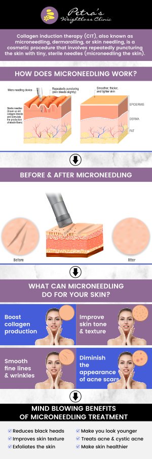 Microneedling is a powerful skin rejuvenation treatment that targets multiple skin concerns, such as signs of aging, pigmentation issues, enlarged pores, and scarring. This non-invasive procedure stimulates collagen production, helping to improve skin texture and tone. At Petra's Weight Loss Clinic, our experienced team provides personalized care to ensure you achieve the best results, addressing your specific skin needs in just a few sessions. For more information, contact us today at Suburban Healthcare Associates or book an appointment online. Our clinic is conveniently located at 7200 N May Ave Suite A Oklahoma City OK 73116. Microneedling is a powerful skin rejuvenation treatment that targets multiple skin concerns, such as signs of aging, pigmentation issues, enlarged pores, and scarring. This non-invasive procedure stimulates collagen production, helping to improve skin texture and tone. At Petra's Weight Loss Clinic, our experienced team provides personalized care to ensure you achieve the best results, addressing your specific skin needs in just a few sessions. For more information, contact us today at Suburban Healthcare Associates or book an appointment online. Our clinic is conveniently located at 7200 N May Ave Suite A Oklahoma City OK 73116.